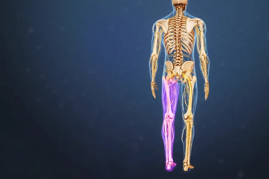 درمان سیاتیک هر دو پا