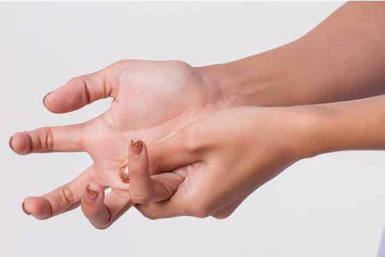 درمان آرتروز دست