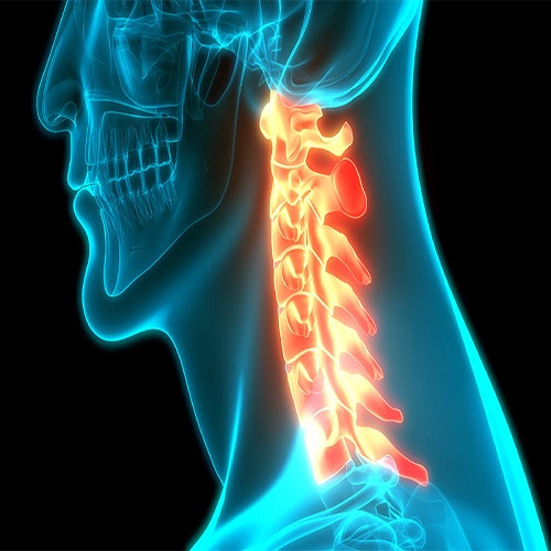 دیسک و آرتروز گردن