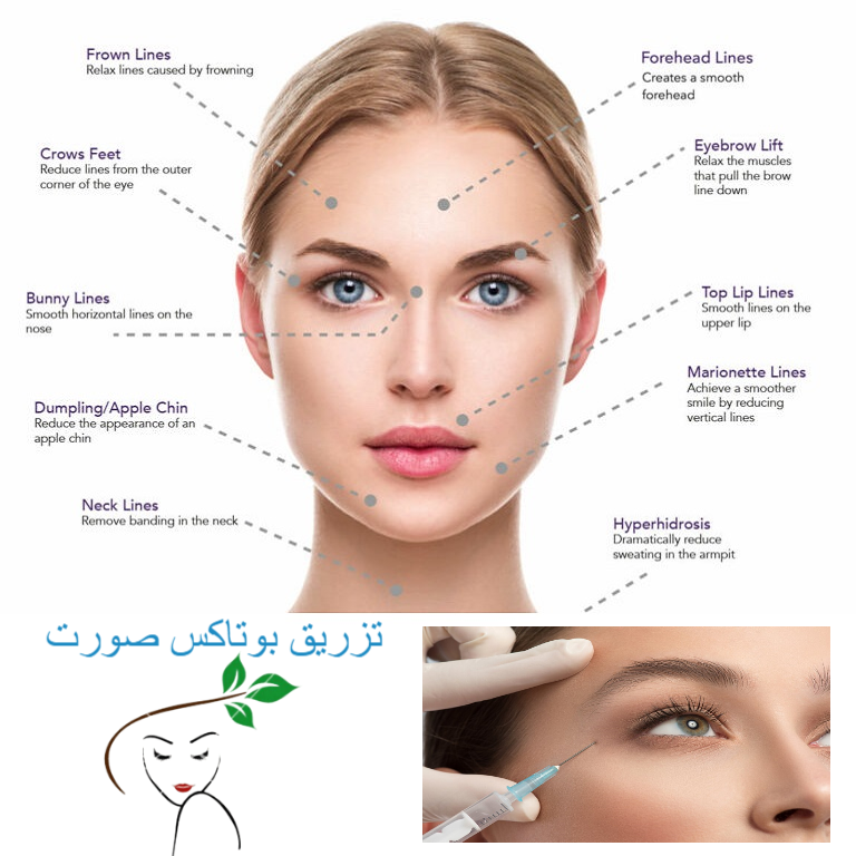 تزریق بوتاکس صورت