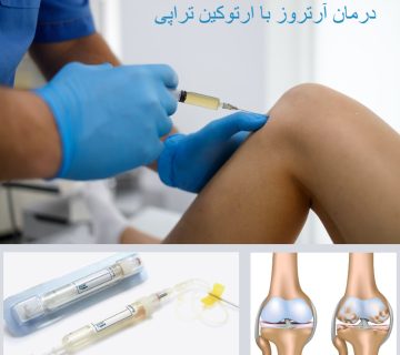 درمان آرتروز با ارتوکین تراپی