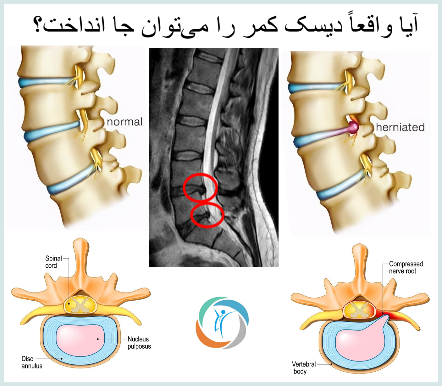 آیا واقعاً دیسک کمر را می‌توان جا انداخت؟