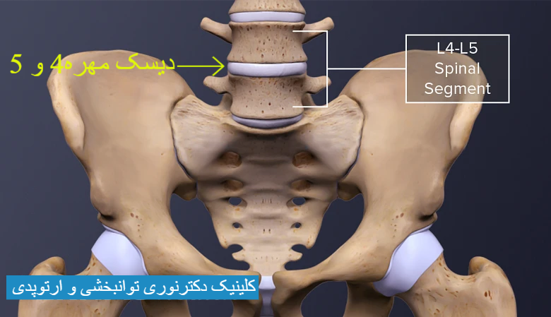 ورزش دیسک کمر مهره 4و5 / دیسک کمر مهره 4و5