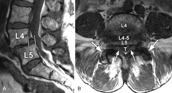 سرخوردگی مهره کمر