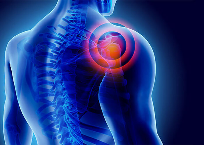 دکتر متخصص شانه و کتف در تهران