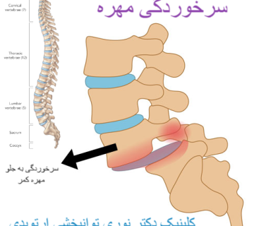 سرخوردگی مهره کمر