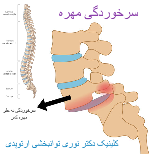 سرخوردگی مهره کمر