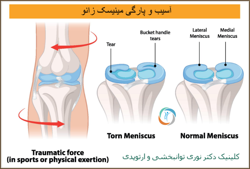 آسیب و پارگی مینیسک زانو