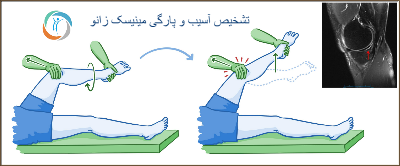تشخیص آسیب و پارگی مینیسک زانو