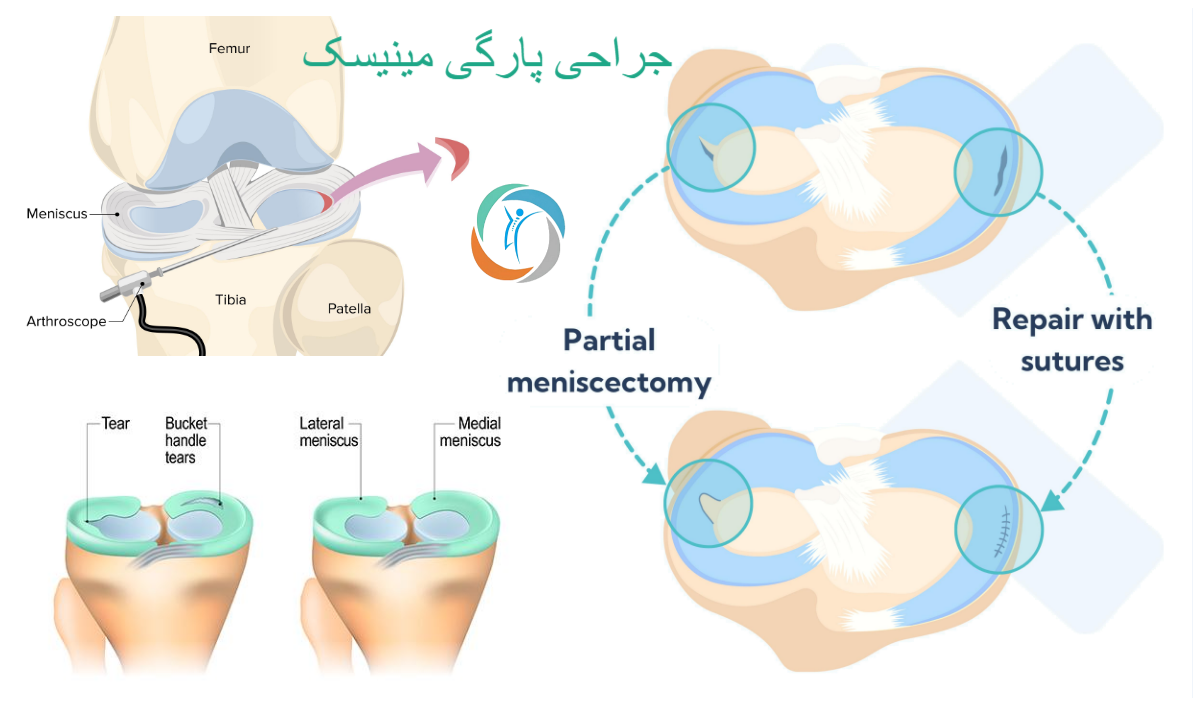 درمان جراحی پارگی مینیسک زانو