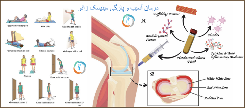 درمان آسیب و پارگی مینیسک زانو