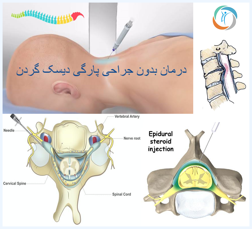 درمان بدون جراحی پارگی دیسک گردن
