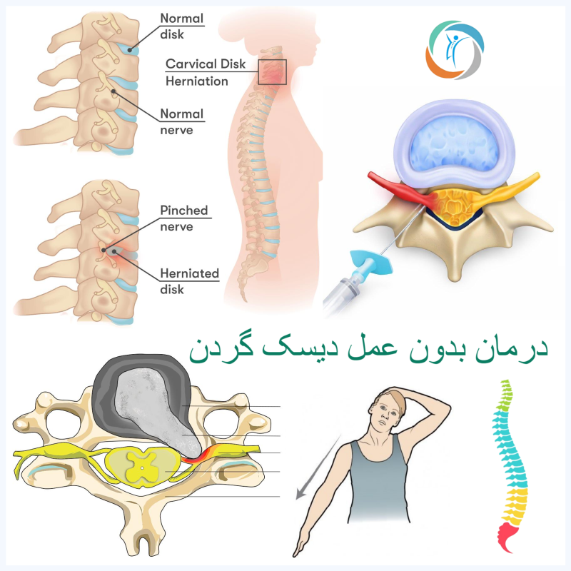 درمان بدون عمل دیسک گردن