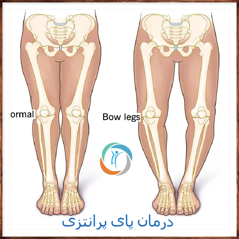 درمان پای پرانتزی