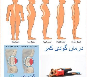درمان گودی کمر
