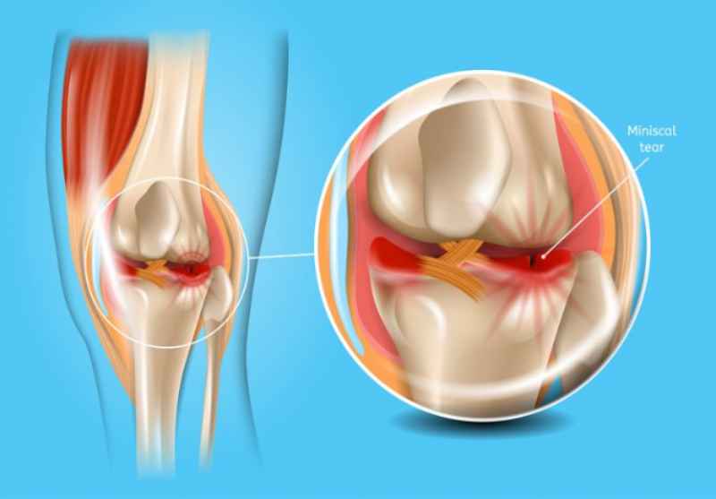 آسیب و پارگی مینیسک زانو