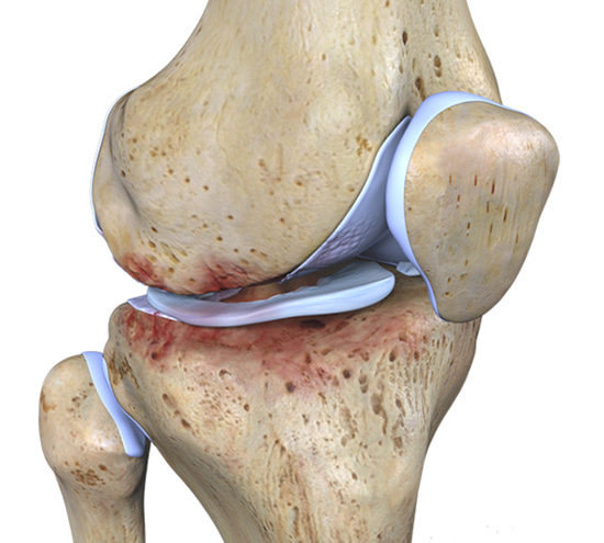 ساییدگی زانو