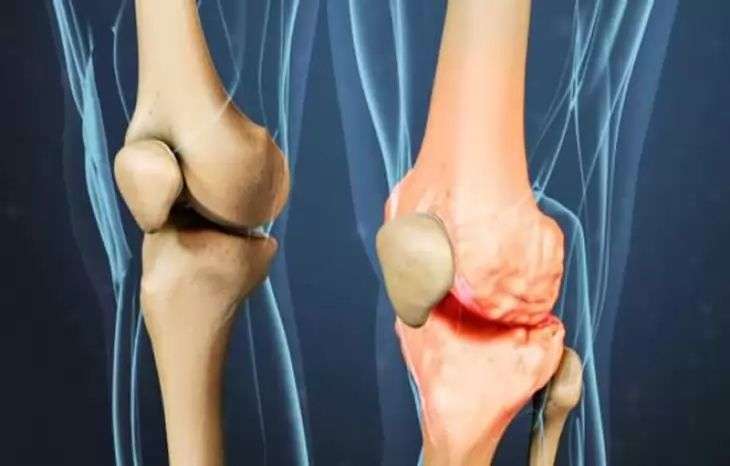 ساییدگی زانو