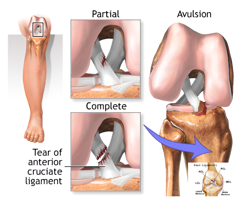 درمان پارگی رباط صلیبی قدامی ACL