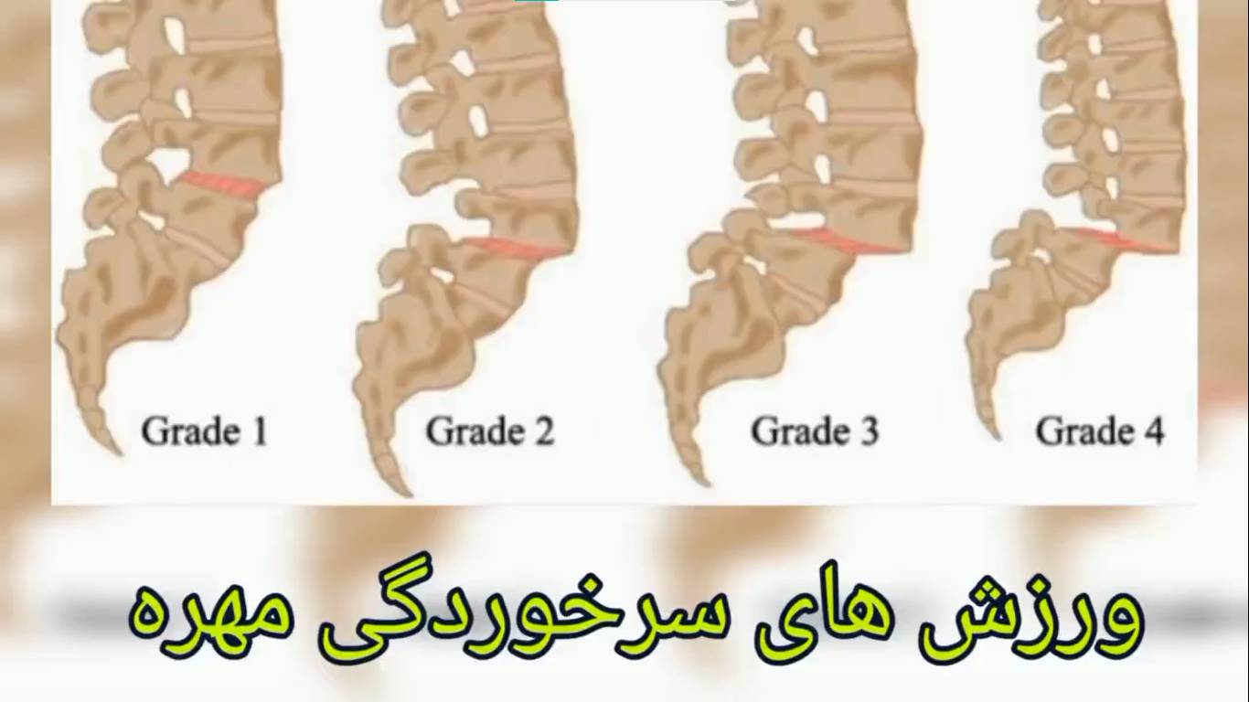 ورزش های سرخوردگی مهره