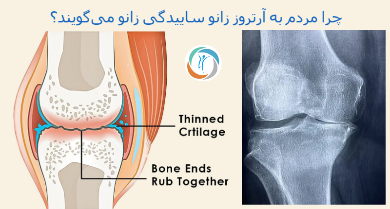 چرا مردم به آرتروز زانو ساییدگی زانو می‌گویند؟