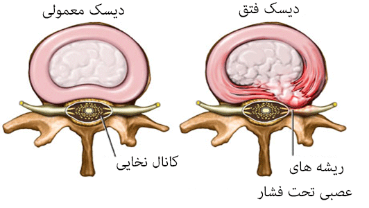 فتق دیسک کمر