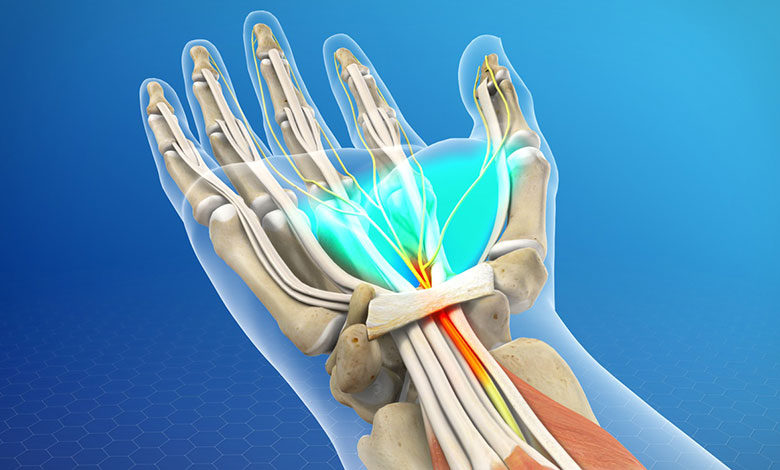 گرفتگی عصب دست