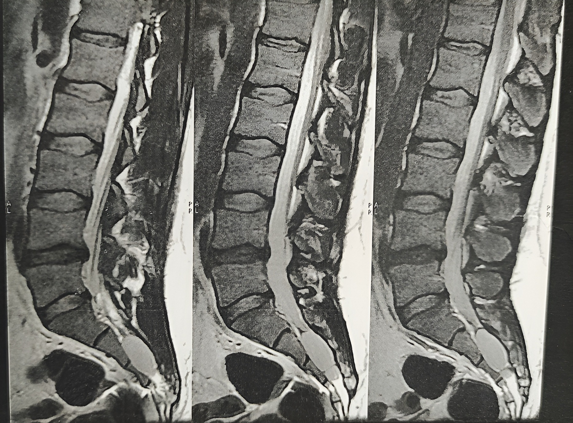 گرفتگی عضلات کمر