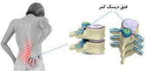 فتق دیسک کمر