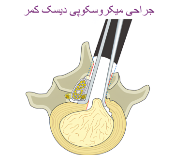 جراحی میکروسکوپی دیسک کمر