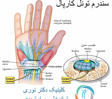 سندرم تونل کارپال