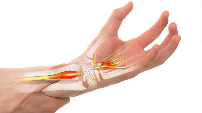 گرفتگی عصب دست