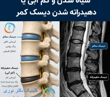 سیاه شدن و کم آبی یا دهیدراته شدن دیسک کمر