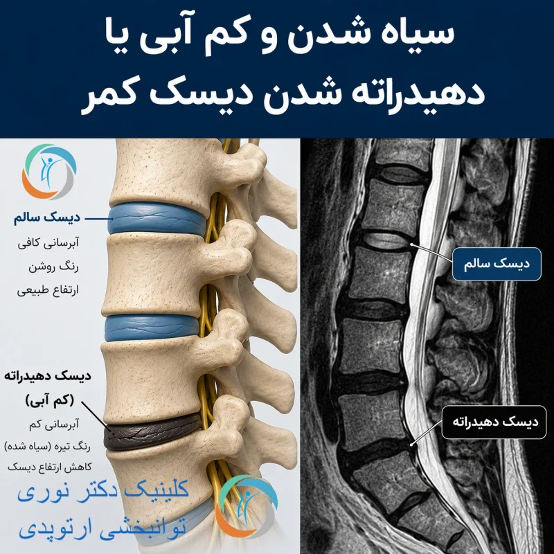 سیاه شدن و کم آبی یا دهیدراته شدن دیسک کمر