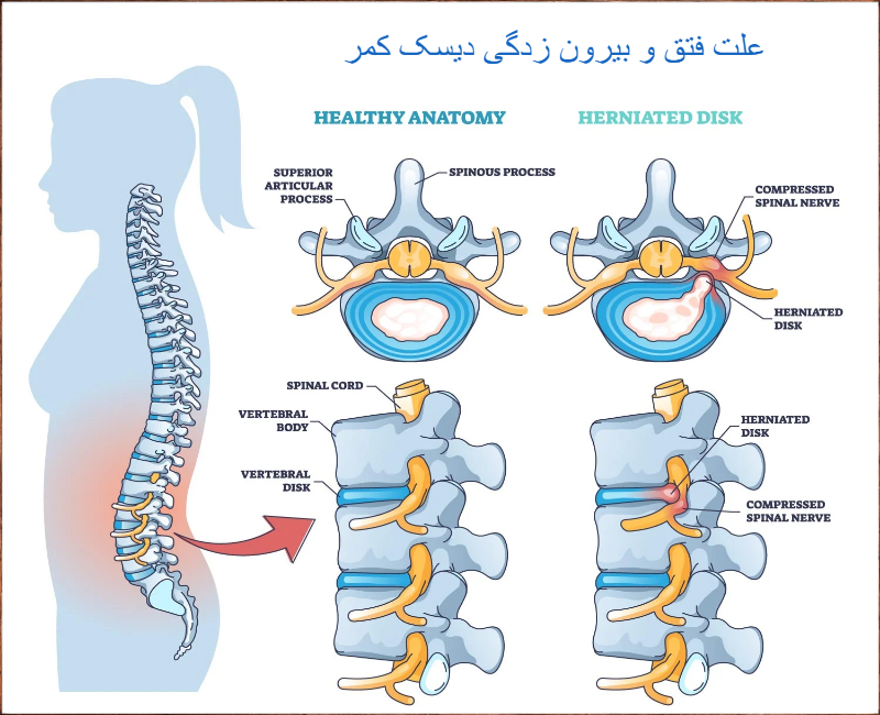 علت فتق دیسک کمر