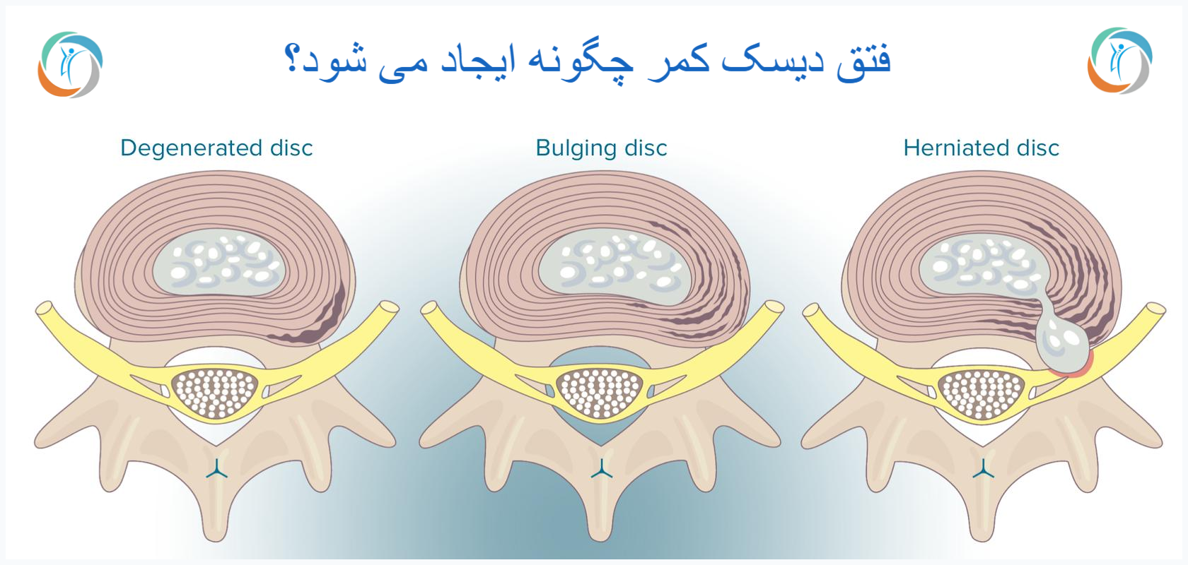 فتق دیسک کمر چگونه ایجاد می شود؟