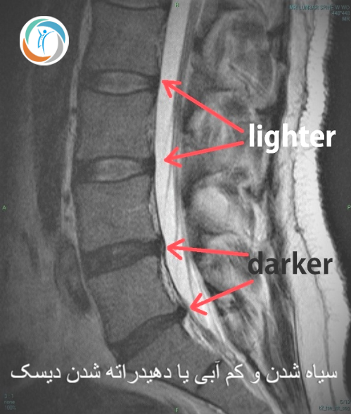 سیاه شدن و کم آبی یا دهیدراته شدن دیسک