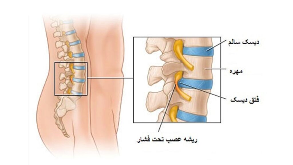بیماری دژنراتیو ستون فقرات