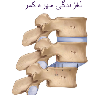 لغزندگی مهره کمر