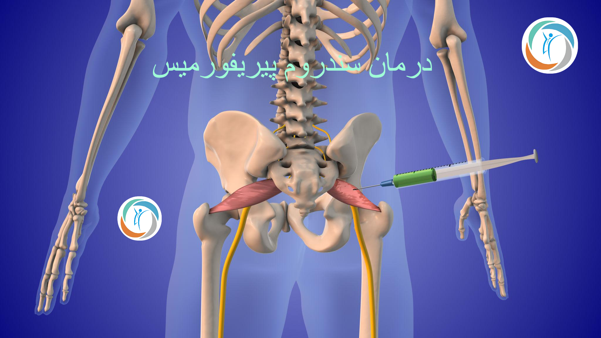 درمان سندروم پیریفورمیس