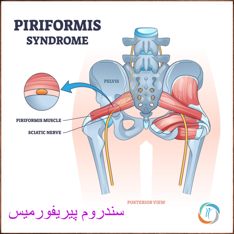 سندروم پیریفورمیس