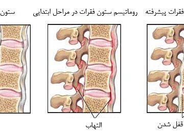 درمان روماتیسم ستون فقرات
