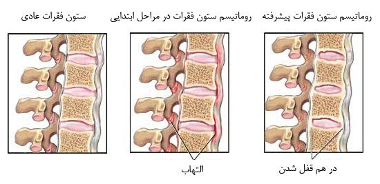 درمان روماتیسم ستون فقرات