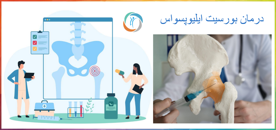 درمان بورسیت ایلیوپسواس