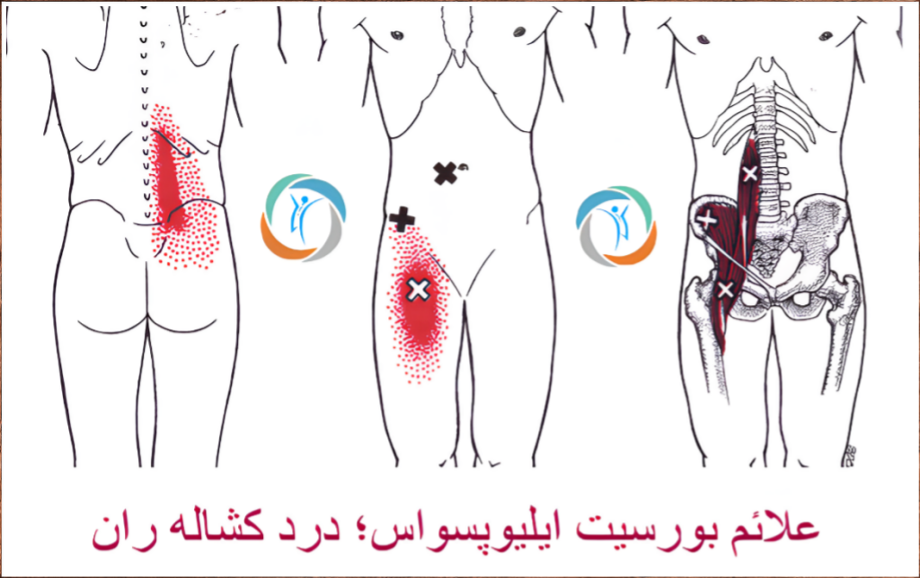 علائم بورسیت ایلیوپسواس؛ درد کشاله ران