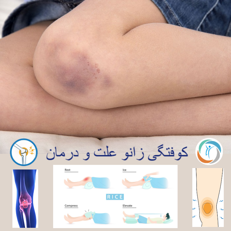 کوفتگی زانو علت و درمان