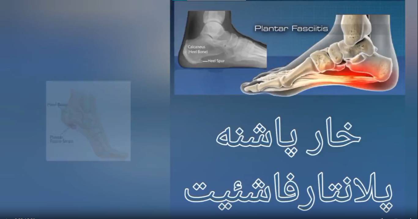 خارپاشنه پلانتارفاشئیت