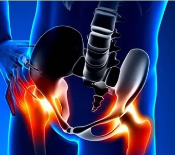 پارگی لابرال لگن