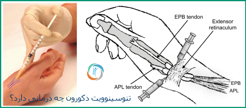 تنوسینوویت دکورون چه درمانی دارد؟