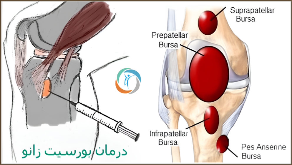 درمان بورسیت زانو